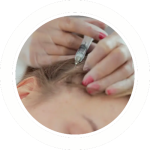 Intradermoterapia - Microagulhamento